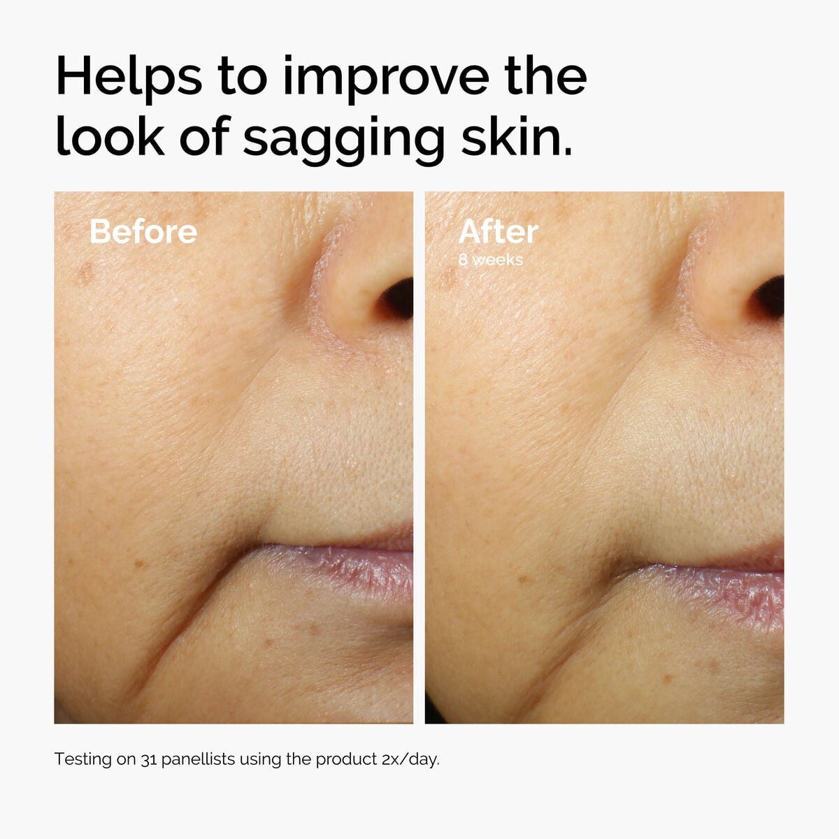 Before and after comparison showing improvements in the look of sagging skin. After 8 weeks of using Caffeine 3% + Escin 1% Face Serum twice daily, the appearance of skin laxity is visibly reduced.
